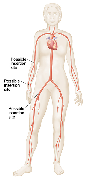 Silhouette of woman showing catheter insertion sites in groin and arm.