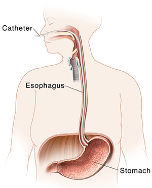 Outline of woman showing mouth, esophagus, and stomach. Esophageal manometry catheter inserted through nose to stomach.