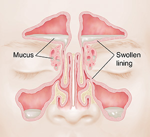 Front view of sinuses showing pale, swollen mucosa and mucus buildup.