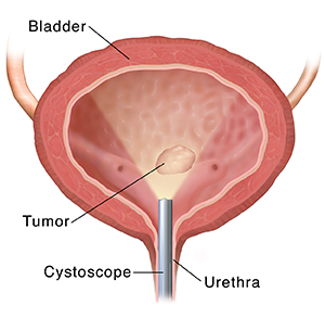 Front view cross section of bladder showing cystoscope inserted through ureter.
