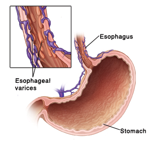 Cross section of esophagus and stomach showing veins around top part of stomach and lower esophagus. Closeup of cross section of lower esophagus showing esophageal varices.