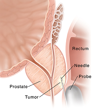 Cross section of prostate and rectum showing needle biopsy of prostate.