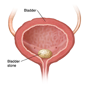 Cross section of bladder showing bladder stone.
