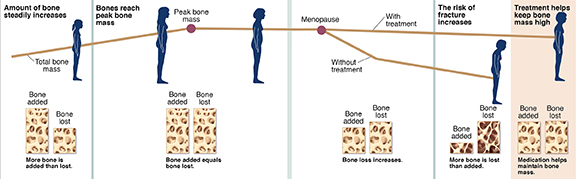 Graph showing bone growth and loss over woman's lifespan, with and without treatment for osteoporosis.