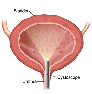 Front view cross section of bladder showing cystoscope inserted through urethra.