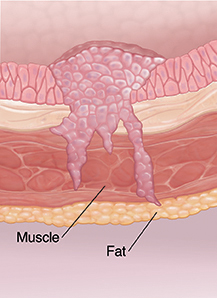 Cross section of bladder wall showing cancer at invasive stage.