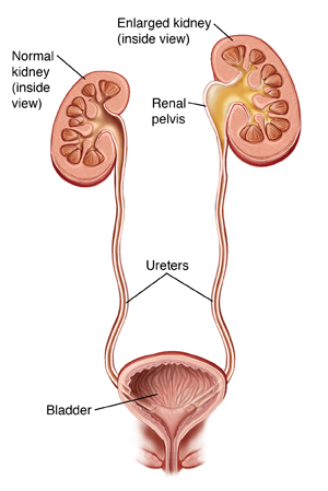 Front view cross section of kidneys, ureters, and bladder. Left ureter is closed off near kidney, with urine backing up into kidney.