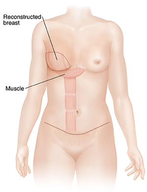 Front view of female outline showing flap breast reconstruction.