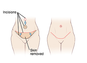 Two images of female abdomen: First image shows incisions and tissue removed for abdominoplasty. Second image shows final result of abdominoplasty.