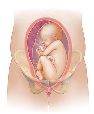 Front view cross section of uterus in pelvic bones showing fetus with head up, in wrong position for birth.