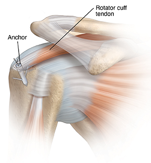 Front view of shoulder joint with anchor repairing torn tendon.