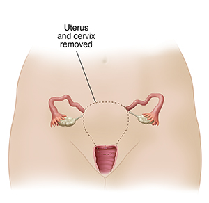 Front view of woman's pelvis showing reproductive tract. Dotted line around uterus and cervix shows organs removed in total hysterectomy.