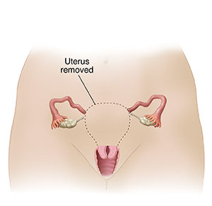 Front view of woman's pelvis showing reproductive tract. Dotted line shows organs removed in subtotal hysterectomy.