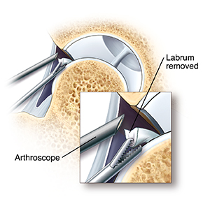 Cross section of hip joint showing arthroscopic instruments removing loose part of labrum. Closeup of arthroscope tip in hip joint and instrument removing part of labrum.