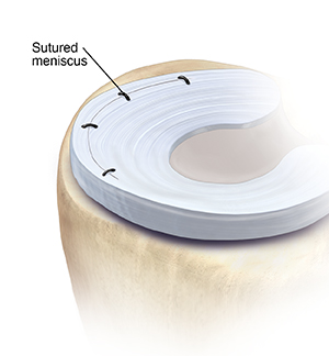 Top view of meniscus showing sutures repairing tear.