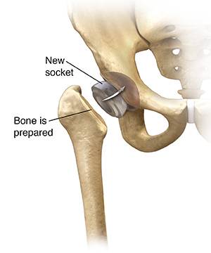 Front view of hip showing socket part of hip replacement being placed.