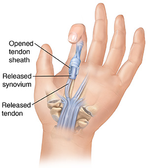 Palm view of hand showing cut tendon sheath repair of trigger finger.