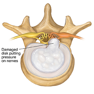 Top view of lumbar vertebra with damaged disk pressing on nerves.