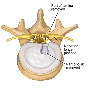 Top view of lumbar vertebra and disk showing rear part of disk removed.