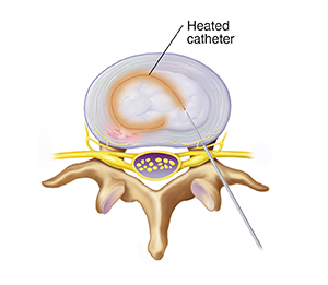 Top view of lumbar vertebra and disk showing cathether heating disk.