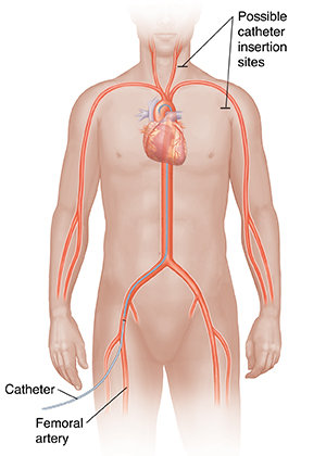 Front view of male figure showing cardiovascular system with catheter inserted in femoral artery to heart. Other possible catheter insertion sites shown.