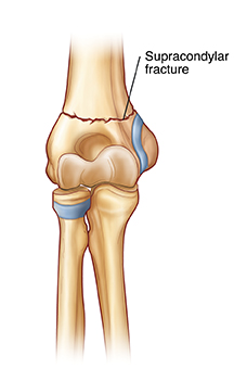 Front view of elbow joint showing supracondylar fracture.