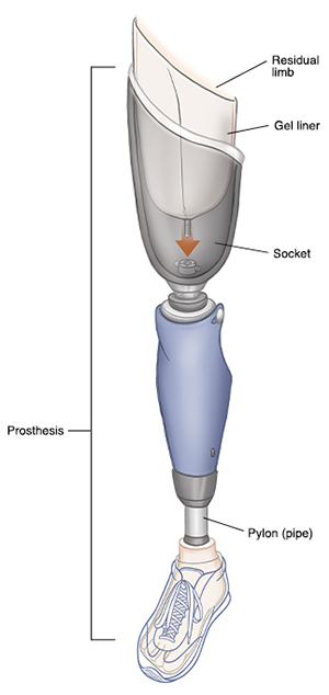 All the parts of an above-the-knee prosthesis.