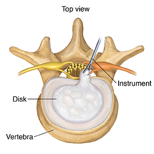 Top view of lumbar vertebra showing posterior removal of herniated disk.