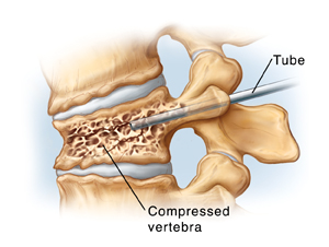 Side view of compressed vertebra and disks. Needle goes through back of vertebra into vertebral body.