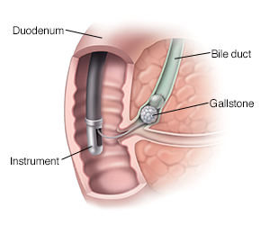 Closeup of common bile duct, pancreas, and duodenum showing ERCP.