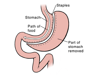 Front view of stomach and duodenum showing sleeve gastrectomy. Arrow shows path of food.