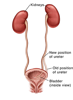 Front view of kidneys, ureters, and bladder. One ureter has been moved to new position on bladder.