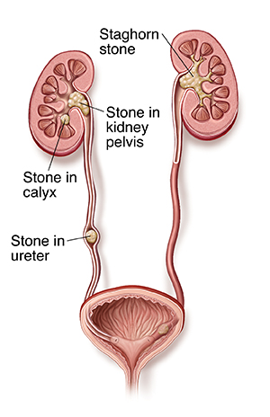 Cross section of urinary tract showing kidney stones. Stones form in kidney calyx. Staghorn stones often caused by infection. May grow until they fill up entire kidney. Some stones move to kidney pelvis, blocking urine flow. Stones often lodge in ureter. This irritates tissue, blocks urine flow, and can make urine bloody.