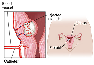 Front view of female pelvis showing cross section of uterus with fibroid. Inset showing closeup of uterine wall with fibroid. Catheter in blood vessel with injected material blocking smaller vessels around fibroid.