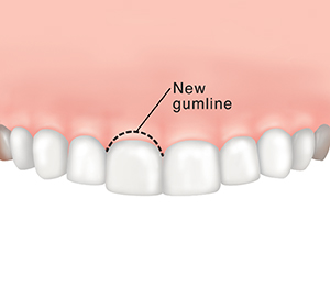 Dotted line showing where gum tissue will be removed above tooth.
