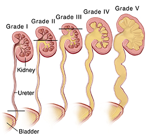 Cross section of kidneys and ureters showing five grades of vesicoureteral reflux.