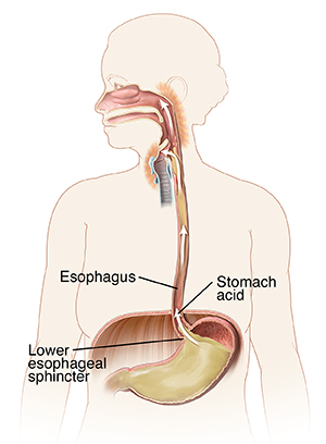 Outline of woman showing mouth, esophagus, and stomach. Arrows show stomach acid flowing up esophagus to irritate back of throat.