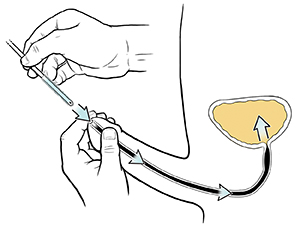 Closeup of hands inserting catheter into penis. 