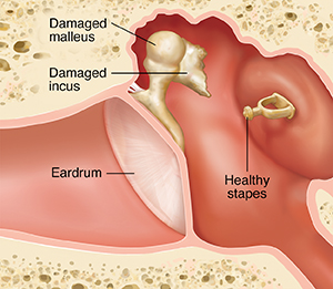 Cross section of ear showing outer, inner, and middle ear structures with damaged incus.