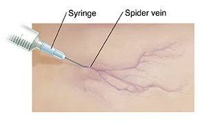Closeup of needle inserted into spider vein.