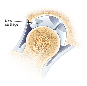 Cross section of hip joint with femoral head moved out of socket. New cartilage has formed over area where small holes were placed.