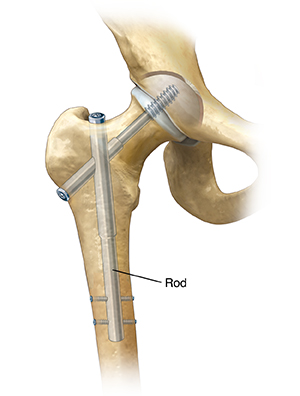 Krames Online - Hip Fracture Surgery: Types