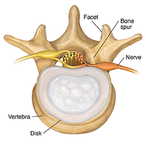 Top view of lumbar vertebra showing bone spurs.
