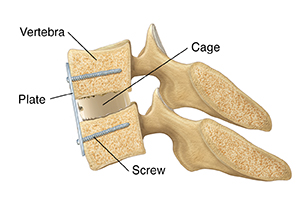 Cross section of cervical vertebrae and disk with cage between vertebrae and plate with screws holding vertebrae together.