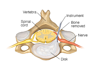 Top view of cervical vertebra and disk with with instrument removing disk from the back.