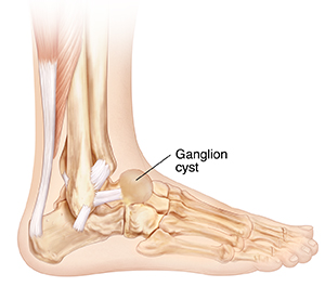 Side view of bones of lower leg and foot showing ganglion cyst.