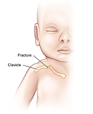 Front view of baby showing fracture in clavicle.
