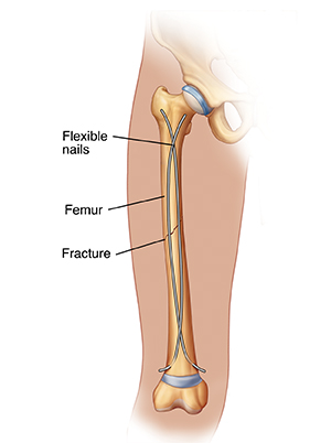 Front view of thigh showing fracture in femur with internal fixation (flexible nails).