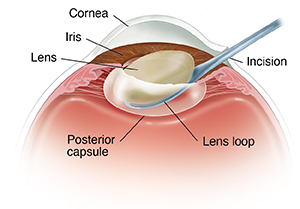 Front view cross section of eye showing instrument removing lens.