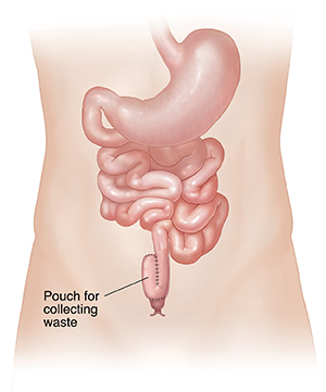 Front view of intestines with the colon and rectum highlighted to show section to be removed.